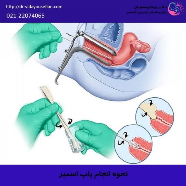  چند روز بعد از پاپ اسمیر می‌توان رابطه جنسی داشت؟