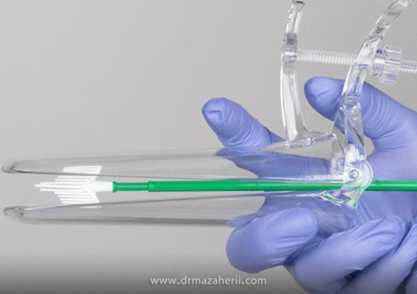  چند روز بعد از پاپ اسمیر می‌توان رابطه جنسی داشت؟