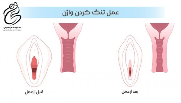  چه چیزهایی باعث تنگ شدن واژن می‌شود؟