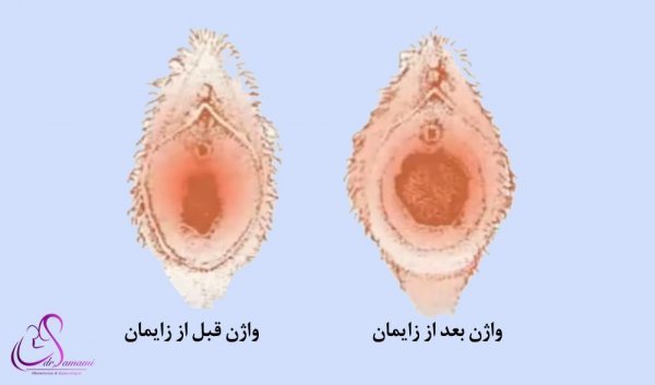 آیا زایمان طبیعی باعث گشادی واژن میشود؟