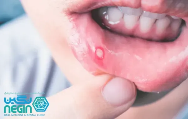  تفاوت جوش و زگیل دهانی + تفاوت آفت دهان با زگیل دهانی