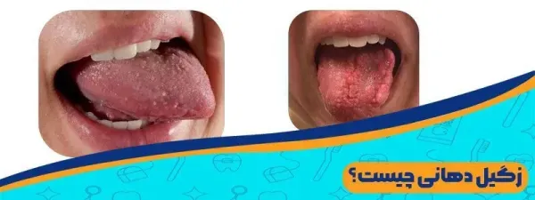  تفاوت جوش و زگیل دهانی + تفاوت آفت دهان با زگیل دهانی