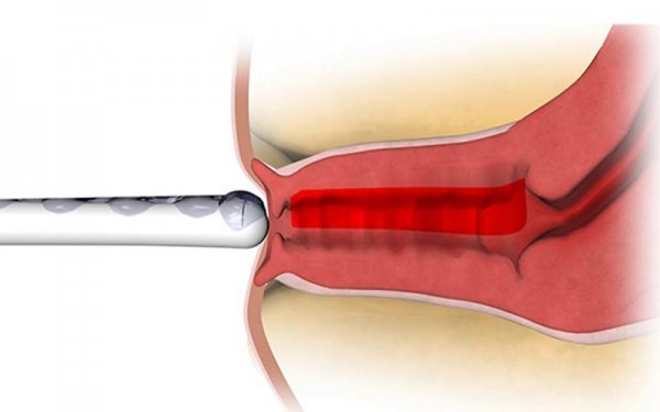  آیا کربوکسی تراپی واژن درد دارد؟