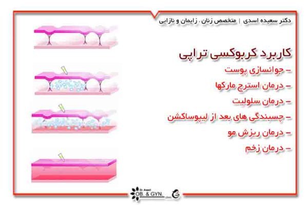  آیا کربوکسی تراپی واژن درد دارد؟