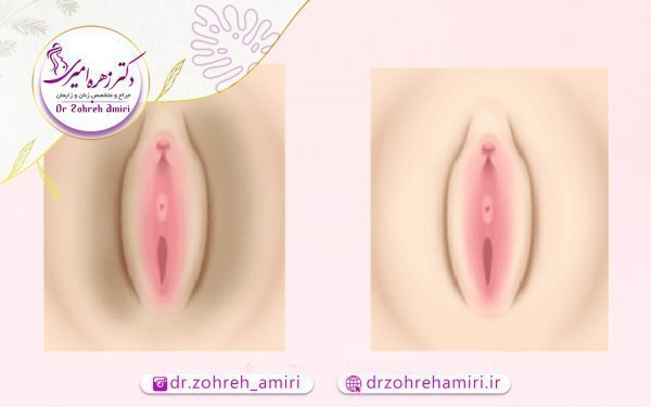  در چه صورتی نیاز به تنگ کردن واژن داریم؟