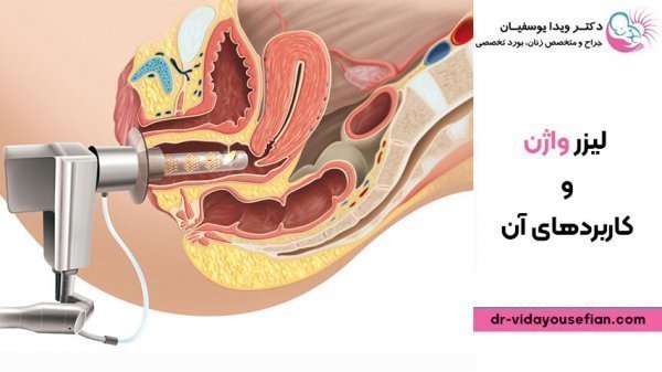  در چه صورتی نیاز به تنگ کردن واژن داریم؟