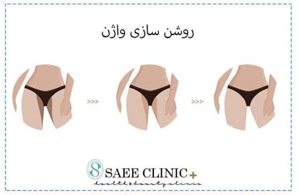  در چه صورتی نیاز به تنگ کردن واژن داریم؟