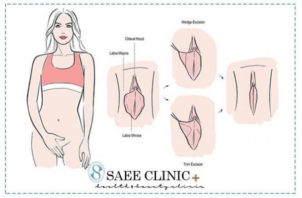  در چه صورتی نیاز به تنگ کردن واژن داریم؟