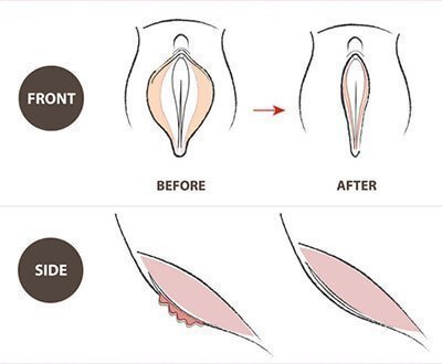  در چه صورتی نیاز به تنگ کردن واژن داریم؟