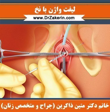  در چه صورتی نیاز به تنگ کردن واژن داریم؟