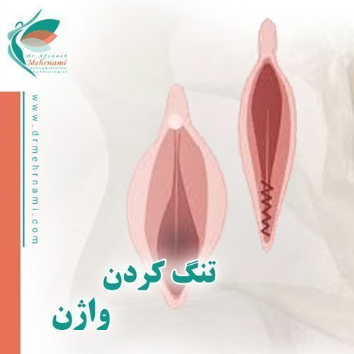  در چه صورتی نیاز به تنگ کردن واژن داریم؟