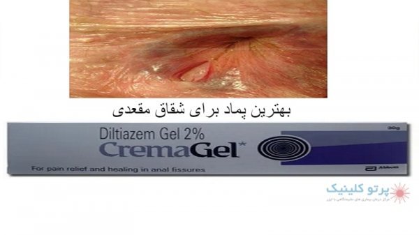 بهترین پماد برای تنگی مقعد