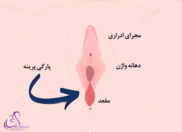  چرا واژن پاره می‌شود؟