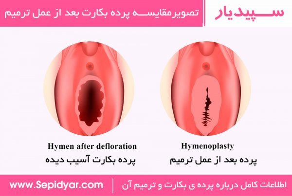 چرا واژن پاره می‌شود؟