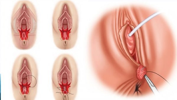  چرا واژن پاره می‌شود؟