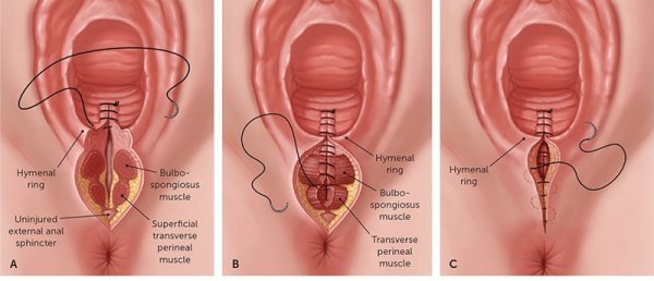  چرا واژن پاره می‌شود؟