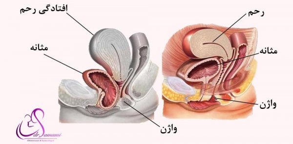  چرا واژن پاره می‌شود؟