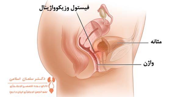  چرا واژن پاره می‌شود؟