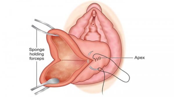  چرا واژن پاره می‌شود؟