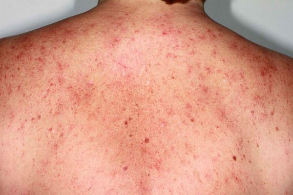  آیا کبد چرب باعث چاقی می‌شود؟