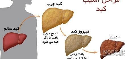  آیا کبد چرب باعث چاقی می‌شود؟