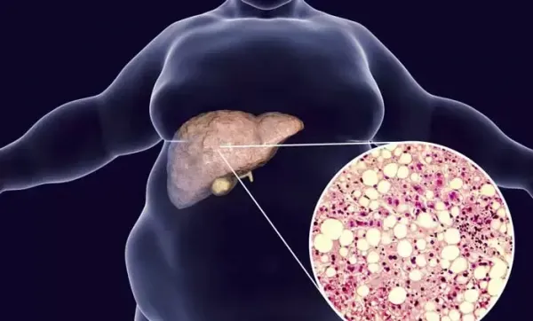  آیا کبد چرب باعث چاقی می‌شود؟