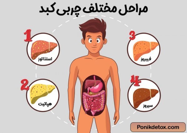  آیا کبد چرب باعث چاقی می‌شود؟