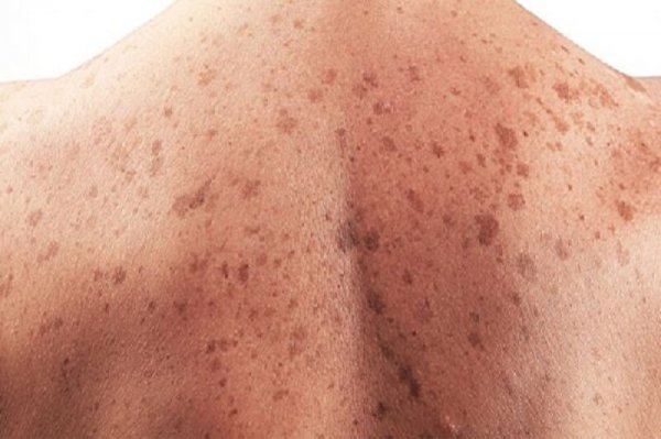  علائم خطرناک کبد چرب