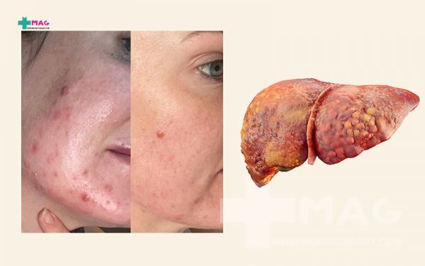  علائم خطرناک کبد چرب