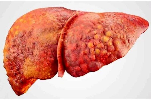  علائم خطرناک کبد چرب