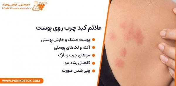  علائم خطرناک کبد چرب