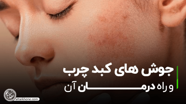 علائم خطرناک کبد چرب