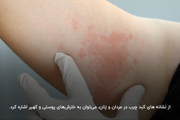  علائم خطرناک کبد چرب