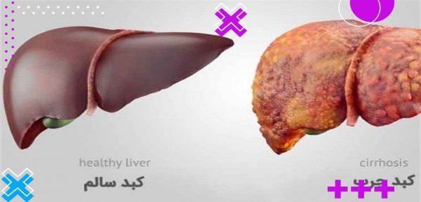  علائم خطرناک کبد چرب