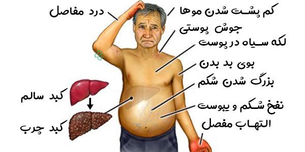  علائم خطرناک کبد چرب