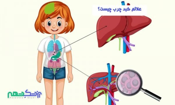  علائم خطرناک کبد چرب