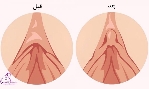  ارگاسم بانوان از طریق تحریک واژن است یا کلیتوریس؟ + عمل زیبایی کلیتوریس