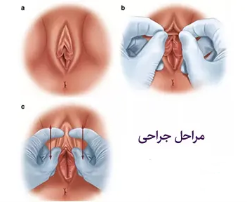  ارگاسم بانوان از طریق تحریک واژن است یا کلیتوریس؟ + عمل زیبایی کلیتوریس