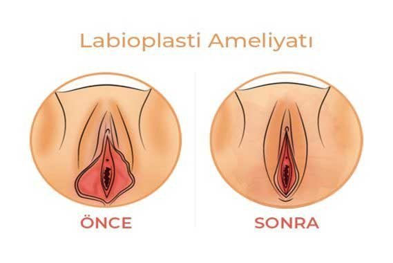  ارگاسم بانوان از طریق تحریک واژن است یا کلیتوریس؟ + عمل زیبایی کلیتوریس