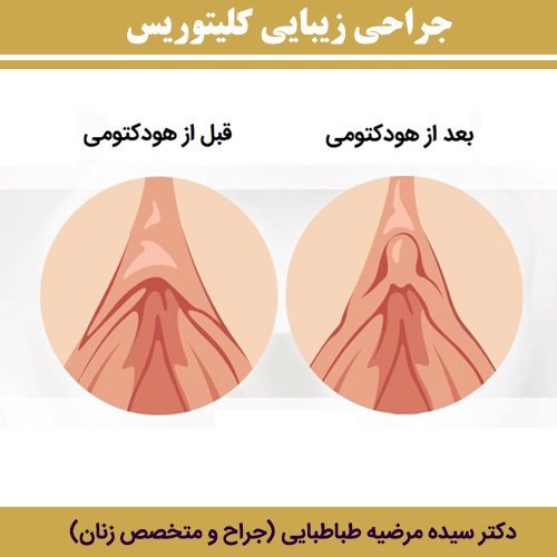  ارگاسم بانوان از طریق تحریک واژن است یا کلیتوریس؟ + عمل زیبایی کلیتوریس