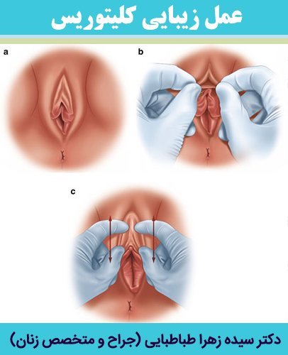  ارگاسم بانوان از طریق تحریک واژن است یا کلیتوریس؟ + عمل زیبایی کلیتوریس