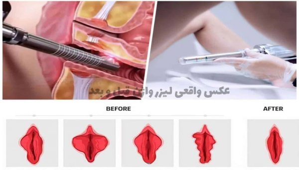  بهترین زمان برای عمل لابیاپلاستی واژن + تنگ کننده واژن اصل و تقلبی