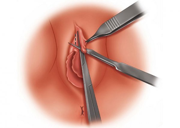  بهترین زمان برای عمل لابیاپلاستی واژن + تنگ کننده واژن اصل و تقلبی