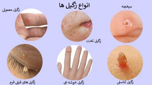  آیا HPV با یک‌ بار سکس منتقل می‌شود+ابتلا به ویروس HPV+ازمایش خون وHPV