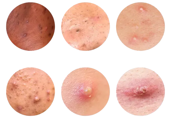  آیا HPV با یک‌ بار سکس منتقل می‌شود+ابتلا به ویروس HPV+ازمایش خون وHPV