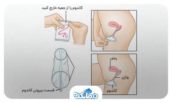  اسپری تاخیری چقدر قبل باید مصرف شود + کاندوم و دیر انزالی + کاندوم زنانه