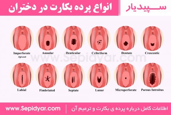  پاره شدن پرده بکارت + قرص ال دی و حالت تهوع + بارداری بدون دخول