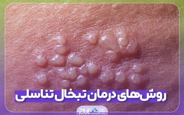  انتقال تبخال تناسلی از طریق لباس + درمان تبخال تناسلی + ویروس هرپس