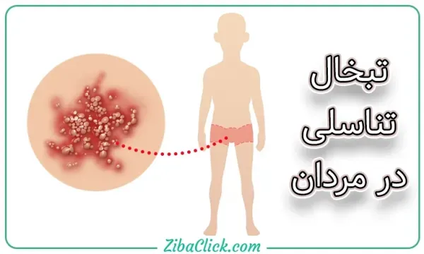  انتقال تبخال تناسلی از طریق لباس + درمان تبخال تناسلی + ویروس هرپس