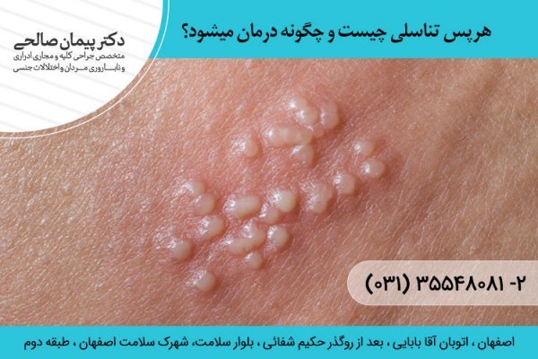  انتقال تبخال تناسلی از طریق لباس + درمان تبخال تناسلی + ویروس هرپس